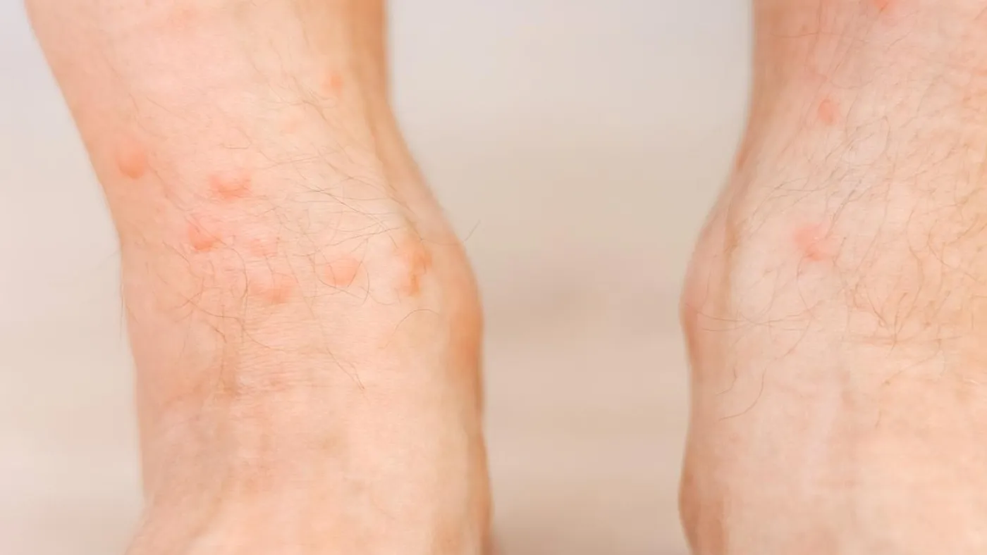 Piqûres de punaises de lit sur les chevilles avec boutons rouges et démangeaisons