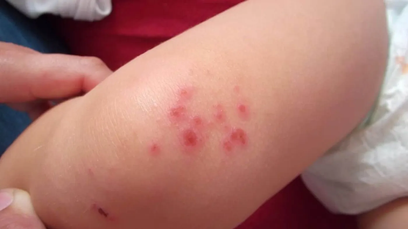 Boutons rouges causés par des piqûres de punaises de lit sur la jambe d’un enfant